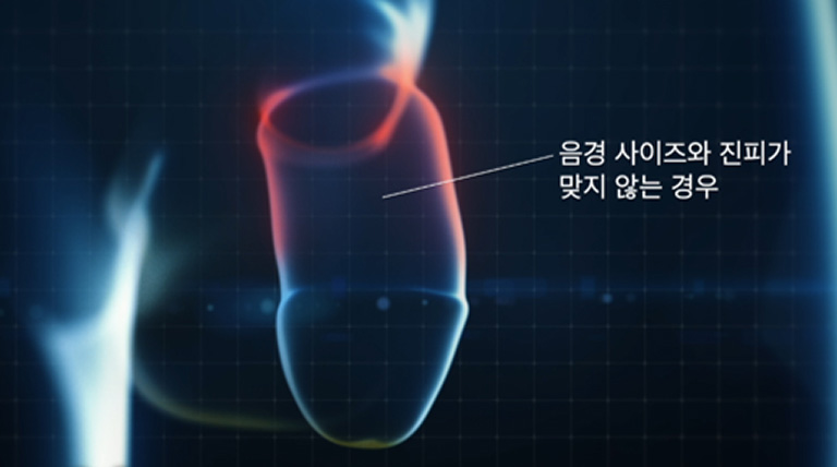 하이스트 비뇨기과 맞춤형 음경 만곡증 교정 및 재건 수술